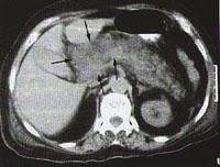 ¿Qué es...?: La pancreatitis aguda