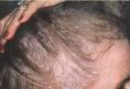 El Sindrome del Cabello Perezoso