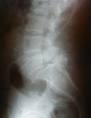 La Espondilolistesis Lumbar