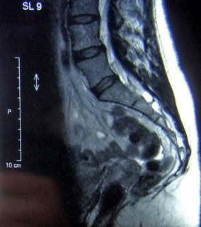 Rarología: Quistes de Tarlov