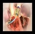 Innovadora Valvula Pulmonar Transcateter