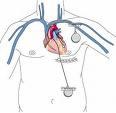 La Ablacion Cardiovascular por Cateter