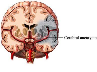 El tipo sanguíneo podría estar asociado a un mayor riesgo de sufrir apoplejías Blog de Farmacia apoplejia El tipo sanguíneo podría estar asociado a un mayor riesgo de sufrir apoplejías