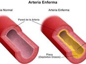 Lipoproteínas plasmáticas arteriosclerosis