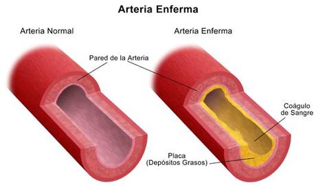 Lipoproteínas plasmáticas y arteriosclerosis Blog de Farmacia aterosclerosis Lipoproteínas plasmáticas y arteriosclerosis