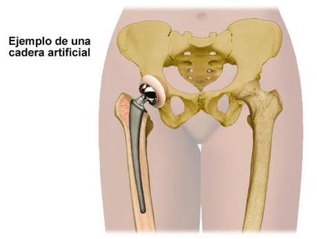 cadera protesis Implantes de prótesis de cadera