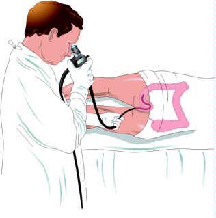 sigmoidoscopy ¿Cuándo realizarse una Sigmoidoscopia?