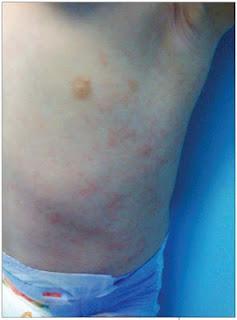 Exantema asimétrico periflexural de la infancia