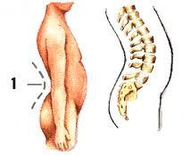 g170 Hiperlordosis y el método Pilates