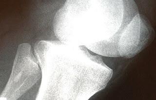 Obesidad y sedentarismo aceleran la paralizante osteoartritis