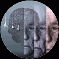 Casos de Demencia Aumentaran en los Próximos Años