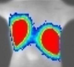 El IDIBELL identifica una proteína útil para predecir el riesgo de metástasis pulmonar en pacientes con cáncer de mama