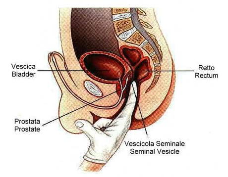 prostata En el cáncer de próstata ¿Cuándo es mejor prevenir que curar?
