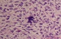 Los Sarcomas de Tejido Blando en los Adultos