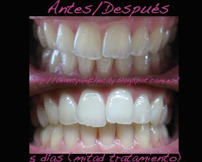 Crest WhiteStrips Supreme - blanqueamiento dental