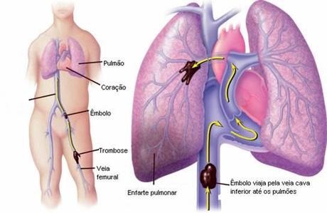 emboliaPulmonar Enfermedades autoinmunes parecen aumentar el riesgo de embolias pulmonares