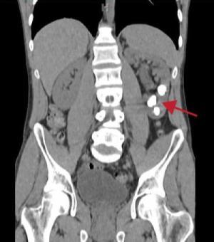 Kidney Stone Mystery Solved: Why Some People Are More Prone to Develop Kidney Stones