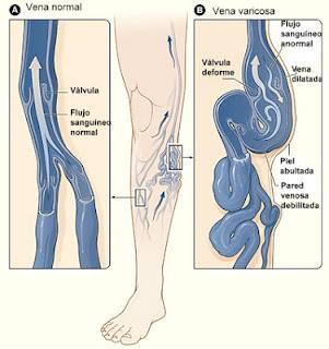 ¿Se pueden prevenir las varices?