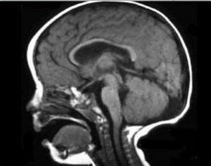 síndrome de Joubert Qué es el síndrome de Joubert