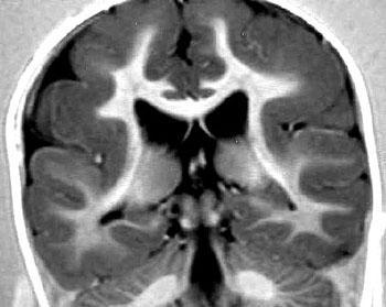 lisencefalia1 Trastornos encefálicos: la lisencefalia