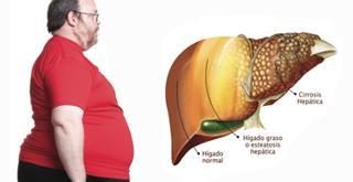 higado graso La enfermedad de hígado graso parece no afectar la sobrevida
