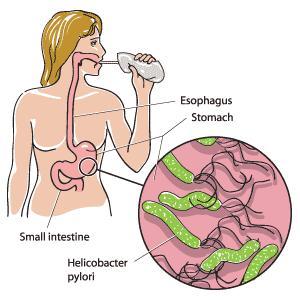 Infección por Helicobacter pylori Blog de Farmacia Helicobactrer Pylori Infección por Helicobacter pylori