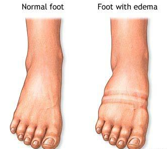 ¿Qué es el Linfedema? Blog de Farmacia linfedema ¿Qué es el Linfedema?