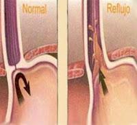 Aprueban Dispositivo que  Elimina el Reflujo Gastroesofagico