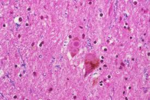 Alzheimer en pacientes con demencia por enfermedad de Parkinson
