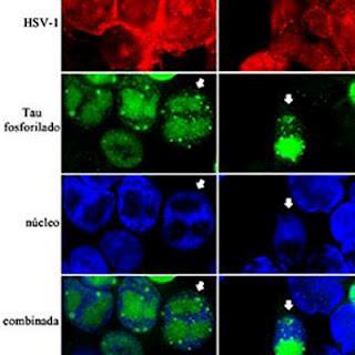 Nuevas evidencias entre el virus Herpes y la enfermedad de Alzheimer