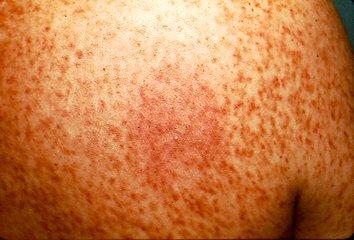 Qué es la Mastocitosis ¿Qué es la Mastocitosis?