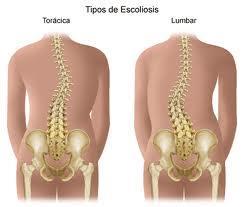  Problemas en la columna: Escoliosis