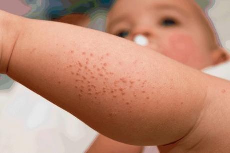 La dermatitis de contacto en el bebé