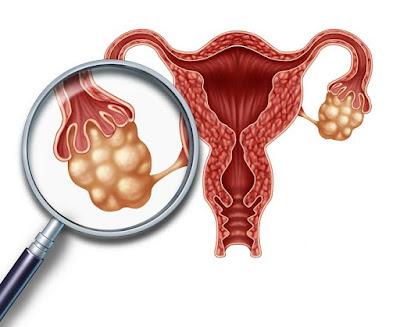 El Síndrome ovárico metabólico poliendocrino