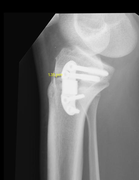 Cambios pos-manejo a nivel de la epífisis proximal de la tibia derecha