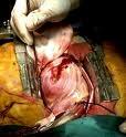 Los Tumores Cardiacos