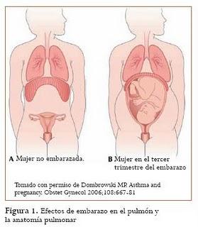 Día Mundial del Asma: embarazo y asma (parte II)