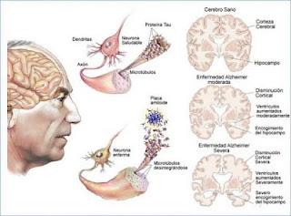 Un 'marcapasos cerebral' para ayudar a pacientes con Alzheimer