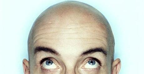 Nuevo hallazgo en cuestiones de calvicie