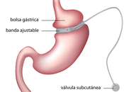 Complicaciones tener cuenta bandas gástricas