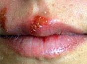 Herpes Labial