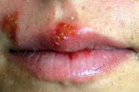 El Herpes Labial