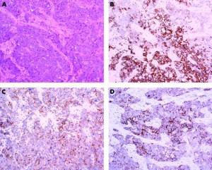 F1.large Nuevo estudio sugiere tratamientos combinados para un tipo de cáncer de mama