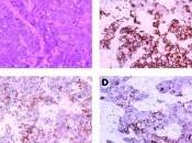 Nuevo estudio sugiere tratamientos combinados para tipo cáncer mama