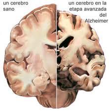 Partes del cerebro más delgadas podrían ser signos de un potencial Alzheimer