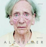Enfermedad de Alzheimer (EA).