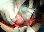 Realiza IMSS trasplantes renales país