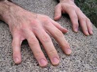 El Síndrome de la Mano Ajena (SMA)