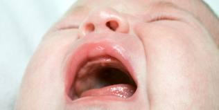 estomatitis bebe ¿qué es la estomatitis en bebés?