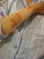 Contusiones y golpes